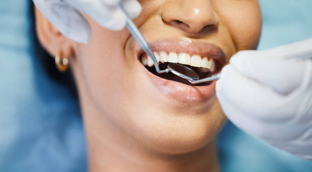 Best Emergency Tooth Extraction in Pleasant Hill, CA